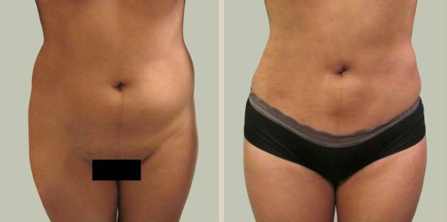 Before and After Image: Before and After Photos: Liposuction - front