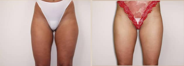 Before and After Image: Before and After Photos: Liposuction - front