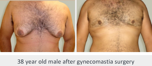 Before and After Image: Before and After Photos: Male Breast Reduction - front