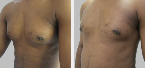 Before and After Image: Before and After Photos: Male Breast Reduction - left-front-oblique