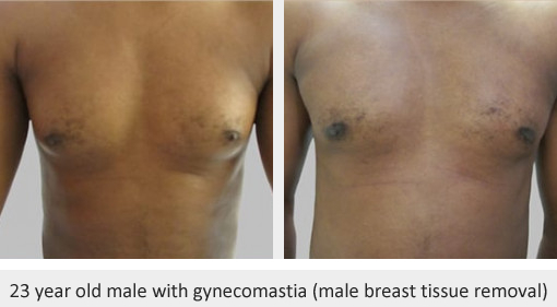 Before and After Image: Before and After Photos: Male Breast Reduction - front