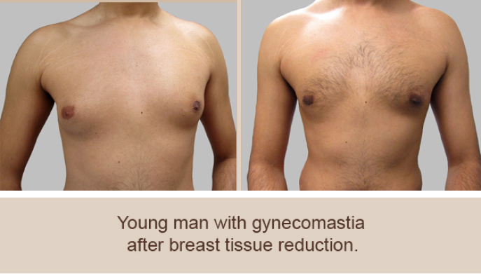 Before and After Image: Before and After Photos: Male Breast Reduction - front