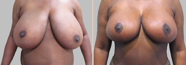 Before and After Image: Before and After Photos: Mommy Makeover - front