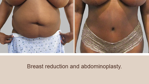 Before and After Image: Before and After Photos: Mommy Makeover - front