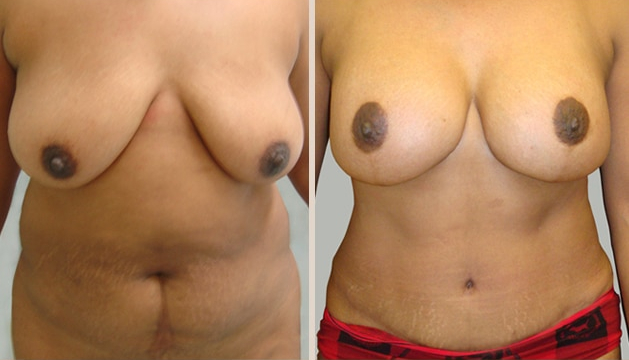 Before and After Image: Before and After Photos: Mommy Makeover - front