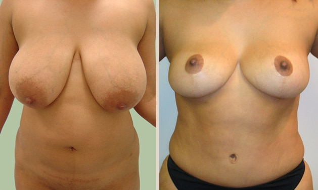 Before and After Image: Before and After Photos: Mommy Makeover - front