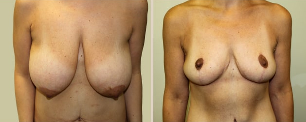 Before and After Image: Before and After Photos: Mommy Makeover - front