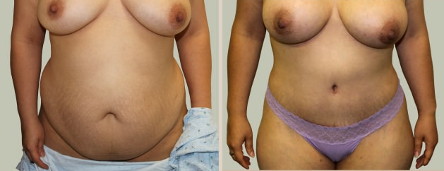 Before and After Image: Before and After Photos: Mommy Makeover - front