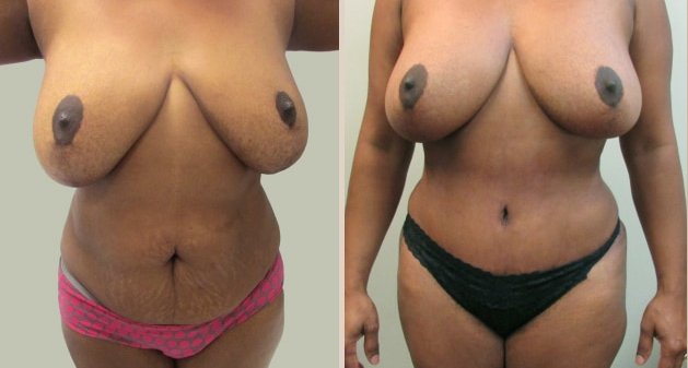 Before and After Image: Before and After Photos: Mommy Makeover - front