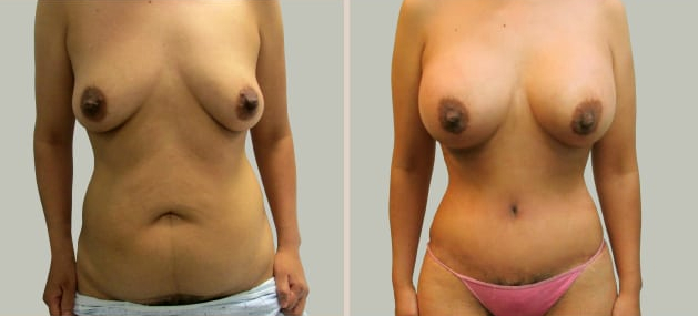 Before and After Image: Before and After Photos: Mommy Makeover - front