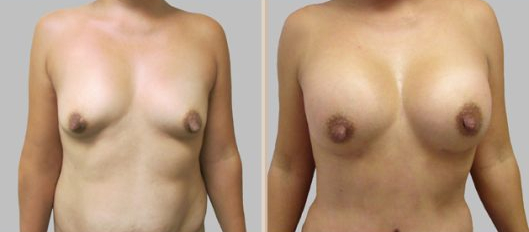 Before and After Image: Before and After Photos: Mommy Makeover - front