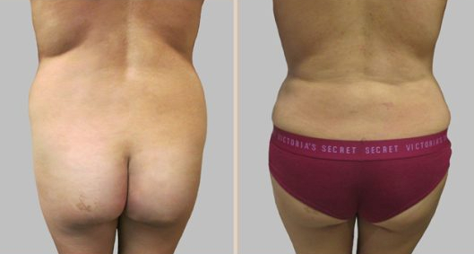 Before and After Image: Before and After Photos: Mommy Makeover - back