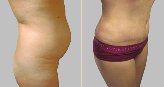 Before and After Image: Before and After Photos: Mommy Makeover - right-side