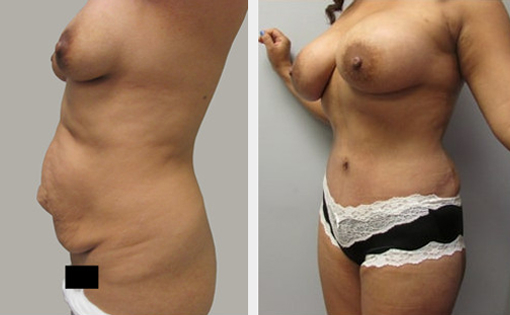 Before and After Image: Before and After Photos: Mommy Makeover - left-front-oblique