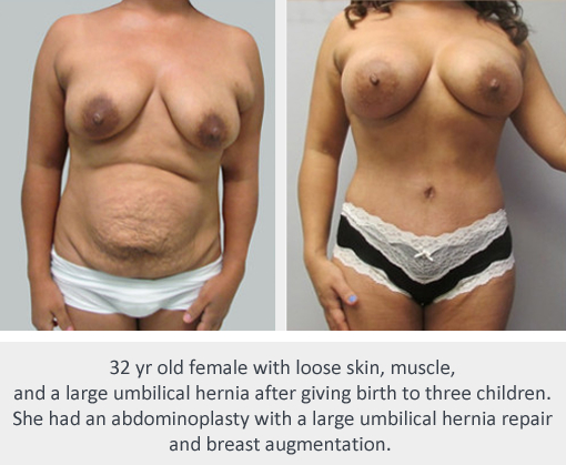 Before and After Image: Before and After Photos: Mommy Makeover - front