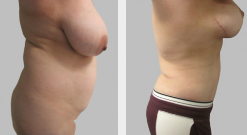 Before and After Image: Before and After Photos: Mommy Makeover - right-side