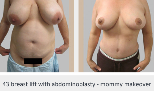 Before and After Image: Before and After Photos: Mommy Makeover - front