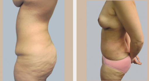 Before and After Image: Before and After Photos: Mommy Makeover - left-side