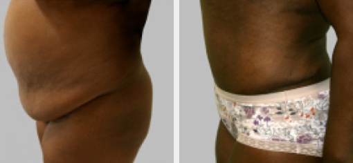 Before and After Image: Before and After Photos: Mommy Makeover - left-side