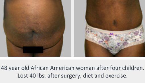 Before and After Image: Before and After Photos: Mommy Makeover - front