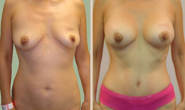 Before and After Image: Before and After Photos: Mommy Makeover - front