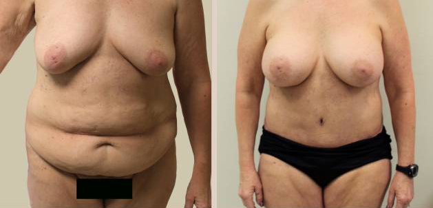 Before and After Image: Before and After Photos: Mommy Makeover - front