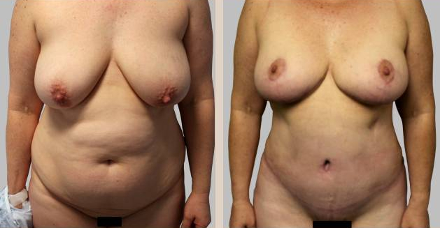 Before and After Image: Before and After Photos: Mommy Makeover - front