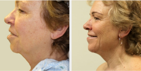 Before and After Image: Before and After Photos: Neck Lift - left-side