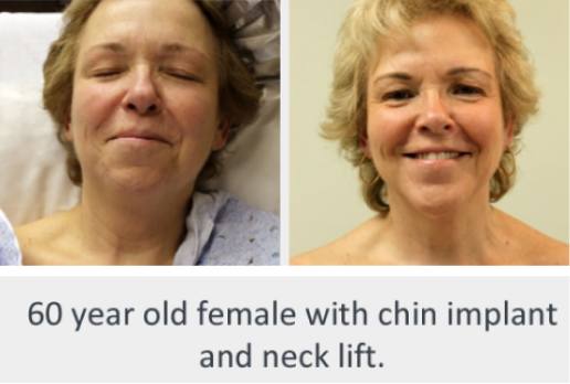 Before and After Image: Before and After Photos: Neck Lift - front