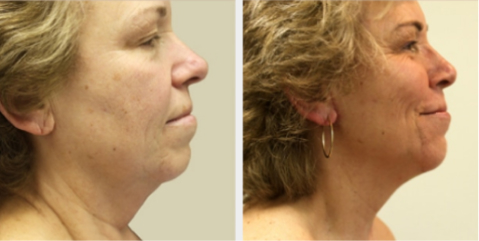 Before and After Image: Before and After Photos: Neck Lift - right-side