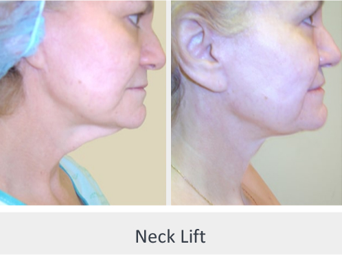 Before and After Image: Before and After Photos: Neck Lift - right-side