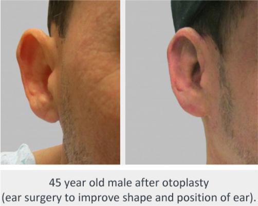 Before and After Image: Before and After Photos: Otoplasty - front