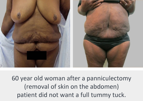 Before and After Image: Panniculectomy - front