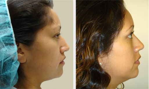 Before and After Image: Before and After Photos: Rhinoplasty (Nose Job) - right-side