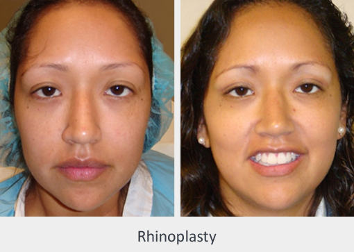 Before and After Image: Before and After Photos: Rhinoplasty (Nose Job) - front