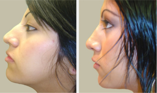 Before and After Image: Before and After Photos: Rhinoplasty (Nose Job) - left-side