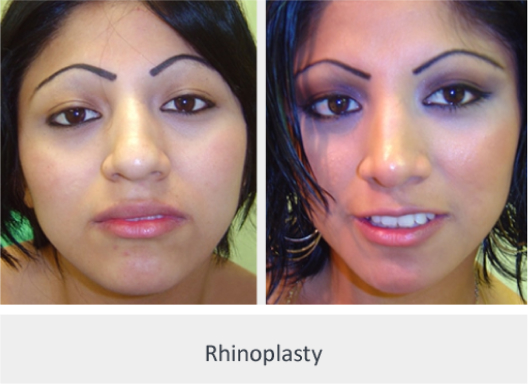 Before and After Image: Before and After Photos: Rhinoplasty (Nose Job) - front