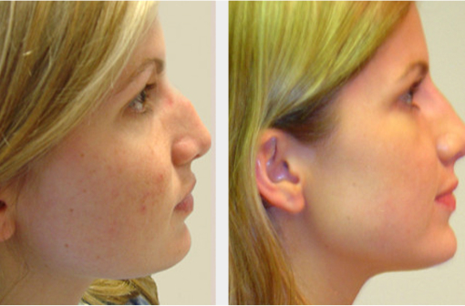 Before and After Image: Before and After Photos: Rhinoplasty (Nose Job) - right-side