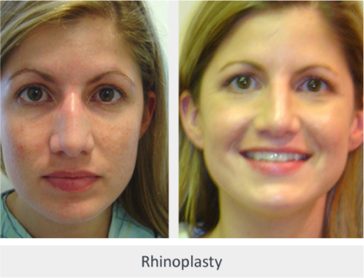 Before and After Image: Before and After Photos: Rhinoplasty (Nose Job) - front