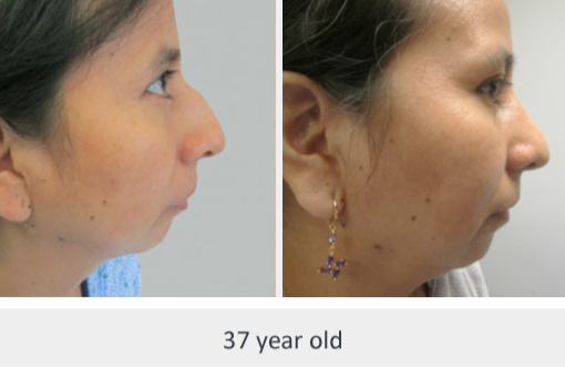 Before and After Image: Before and After Photos: Rhinoplasty (Nose Job) - right-side