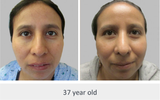 Before and After Image: Before and After Photos: Rhinoplasty (Nose Job) - front