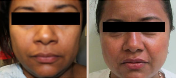 Before and After Image: Before and After Photos: Rhinoplasty (Nose Job) - front