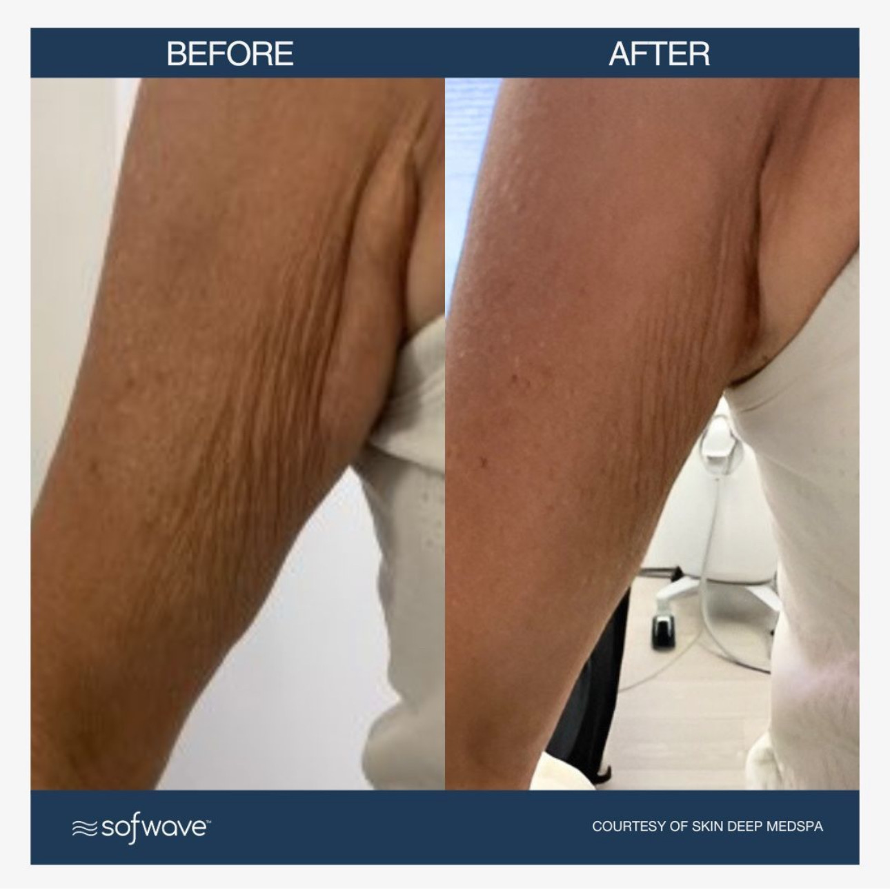 Before and After Image: Before and After Photos: Sofwave - right-front-oblique