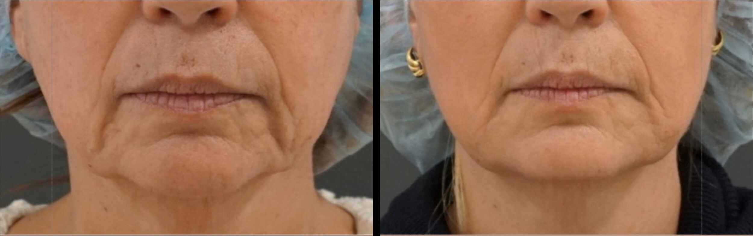 Before and After Image: Before and After Photos: Sofwave - front