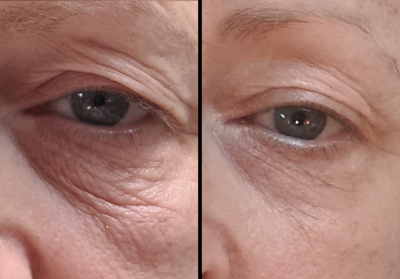 Before and After Image: Before and After Photos: Sofwave - left-front-oblique