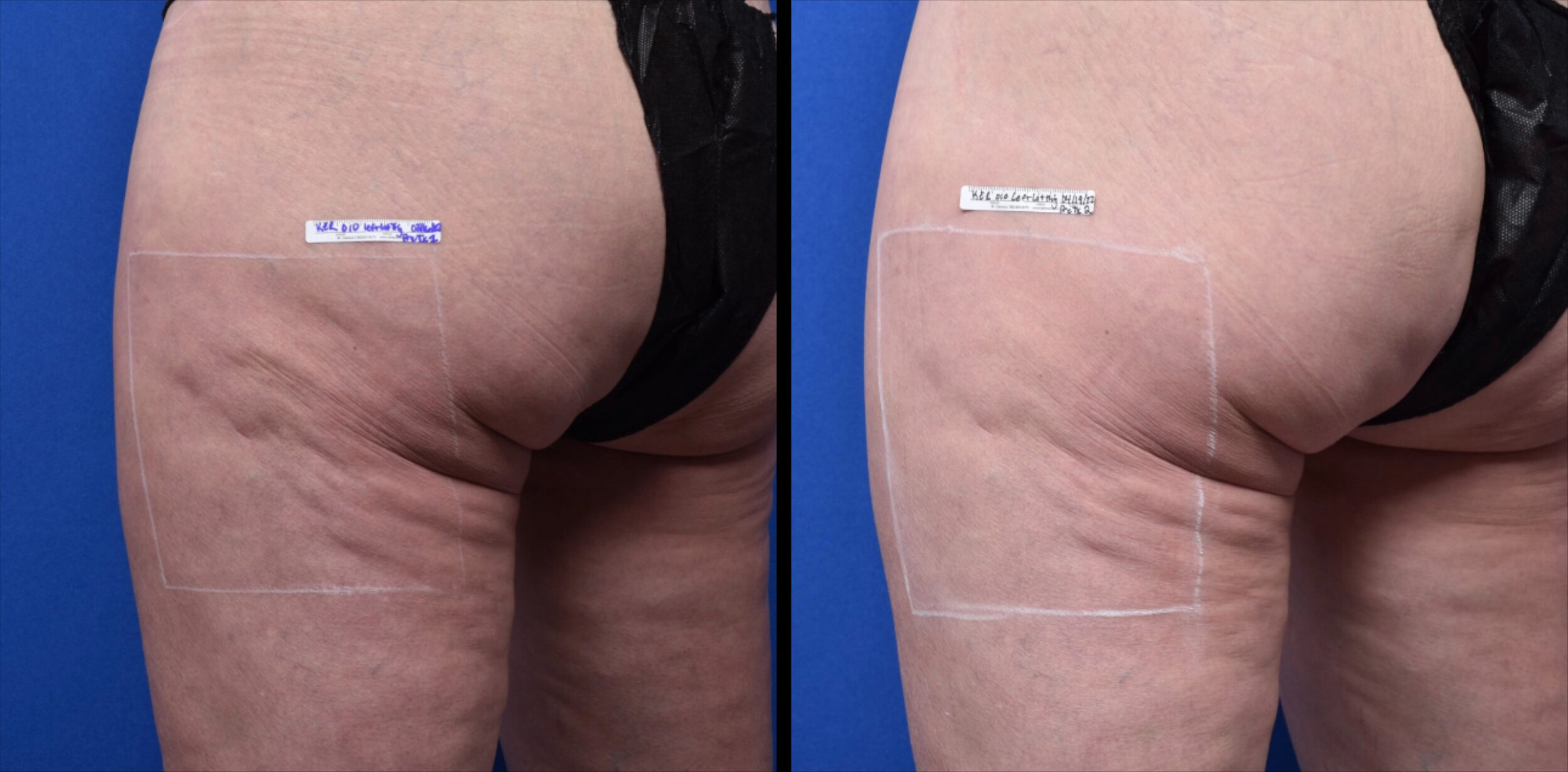 Before and After Image: Before and After Photos: Sofwave - left-back-oblique