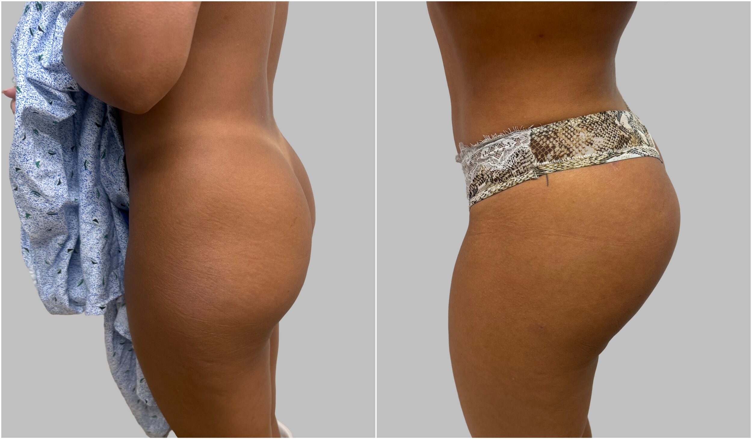 Before and After Image: Before and After Photos: Buttocks Implants - left-side