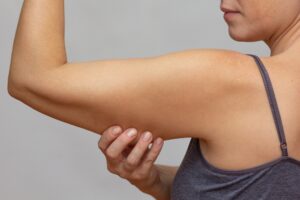 Side profile of a woman flexing her arm and pinching the excess skin on her upper arm, in need of an arm lift.