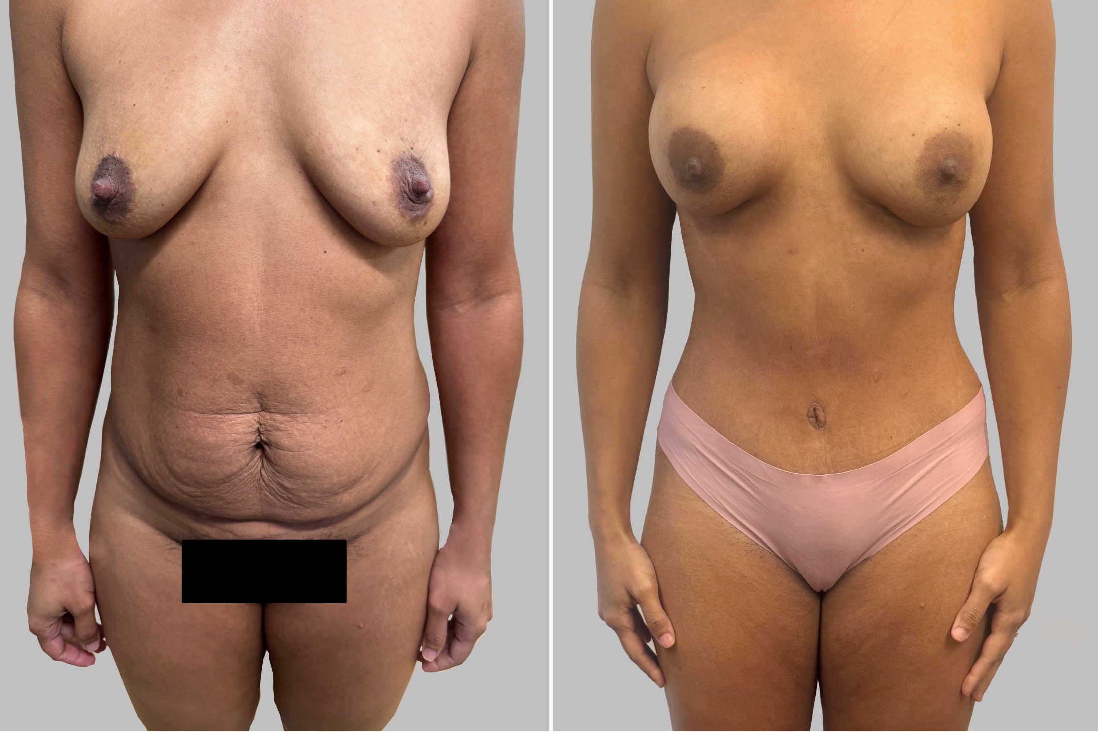 Before and After Image: Before and After Photos: Abdominoplasty and Breast Augmentation - front
