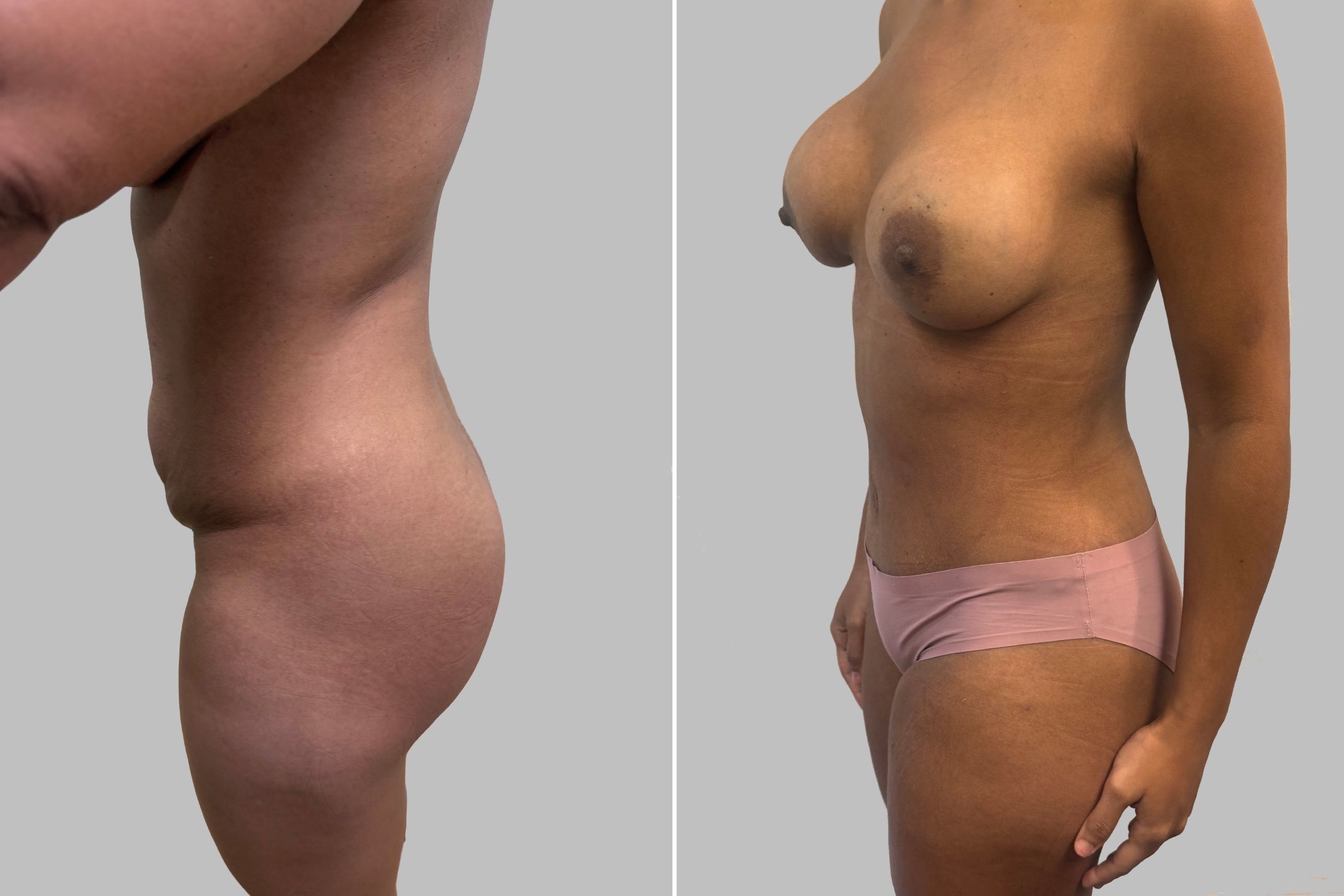 Before and After Image: Before and After Photos: Abdominoplasty and Breast Augmentation - left-front-oblique